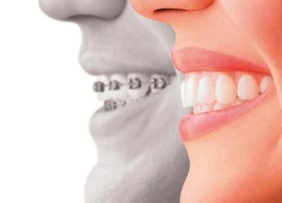 چگونه دندان های مرتب داشته باشیم؟