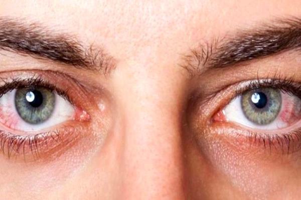 6 بیماری مهم که چشم ها در خصوص آن ها هشدار می دهند